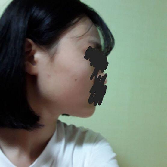 이래도..? 평범한거야? 오늘 친구들한테 나 양악할거라고 떠보는식으로 햇는데 하라면서 그러고 친구폰으로 옆모습을 찍엇는데 진ㅁ자 이상하더라 ..