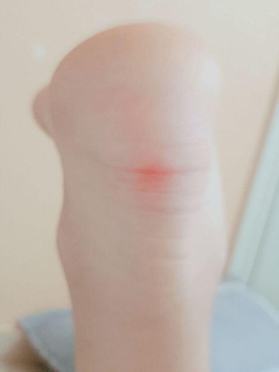 여기에 모기물렸어