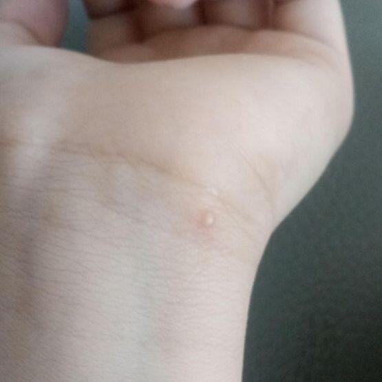 현재 가장 큰 물집은 손목에 난 물집이고 두번째로 큰건 어제 바늘로 터뜨렸다가 다시 살아난 새끼손가락의 물집 그리고 남은 하나의 사진은 3주 전