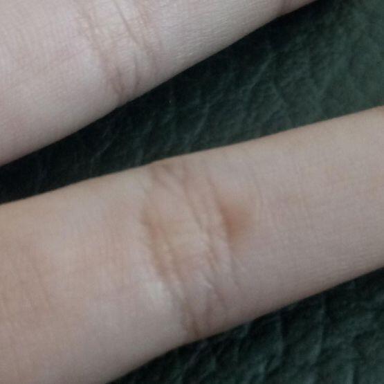 현재 가장 큰 물집은 손목에 난 물집이고 두번째로 큰건 어제 바늘로 터뜨렸다가 다시 살아난 새끼손가락의 물집 그리고 남은 하나의 사진은 3주 전