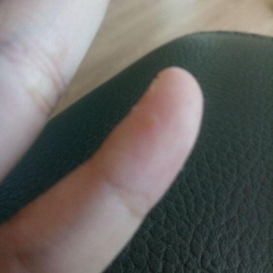 현재 가장 큰 물집은 손목에 난 물집이고 두번째로 큰건 어제 바늘로 터뜨렸다가 다시 살아난 새끼손가락의 물집 그리고 남은 하나의 사진은 3주 전