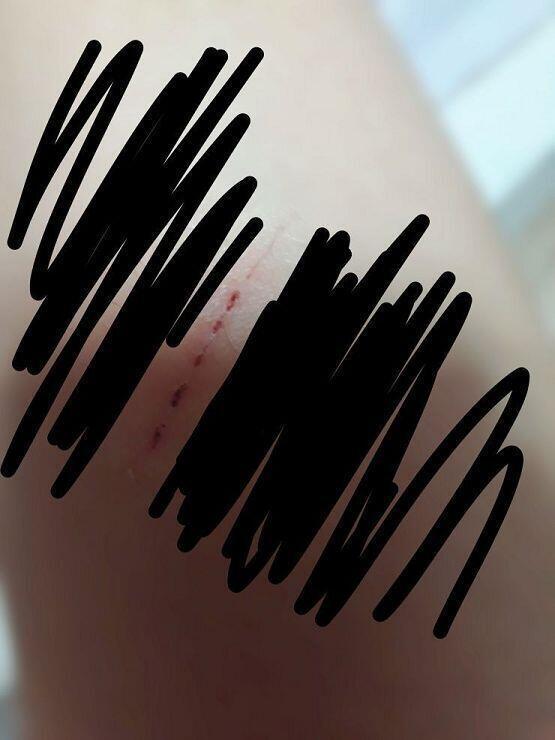 그리고 그 날 아침에 일어나서 교복 갈아입다가 침대 모서리에 긁혀서 피 낫쪄ㅜㅜㅜ 2일 전 이라 지금은 딱지 졌어 ..