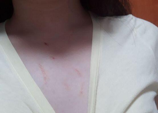 아빠한테 간다고 말했다가 맞아서 난상처야. 참고로 이틀전에는 이거보다 훨씬더 심했어