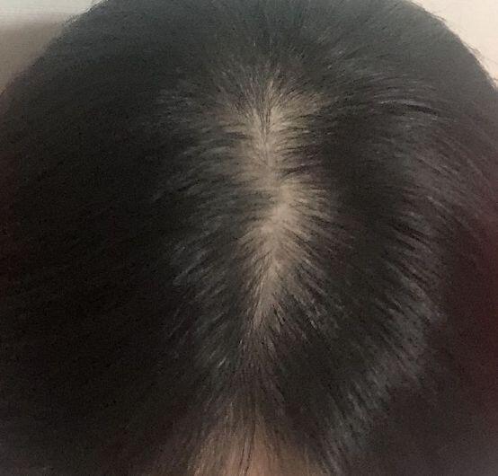 미녹시딜 관리 전. 머리의 상태가 좀 심하다. 두번째는 가마가 드러나면 저렇게 되는 거긴 한데 ㅜㅜ (쌍가마) 미녹시딜 관리 시작하면 뭔가 달라