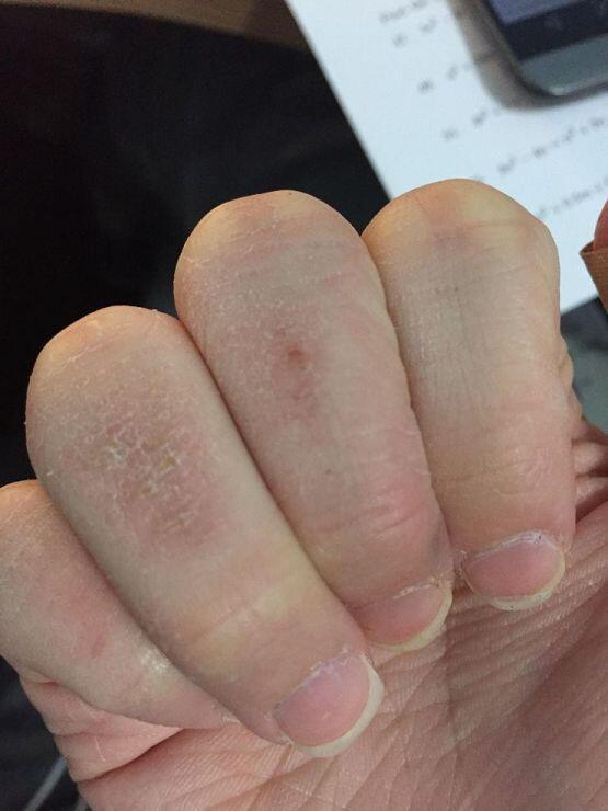 혐오감 느낄수도 있으니까 이미지 조심해.... 함부로 보지 말고... 사실 이 정도면 굉장히 양호한가긴 하다 ㅋㅋㅋㅋㅋㅋㅋ 지금 상태 매우 좋은
