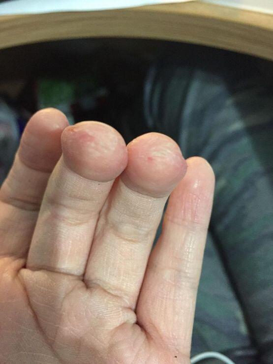 혐오감 느낄수도 있으니까 이미지 조심해.... 함부로 보지 말고... 사실 이 정도면 굉장히 양호한가긴 하다 ㅋㅋㅋㅋㅋㅋㅋ 지금 상태 매우 좋은