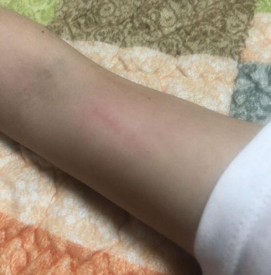 집에도착해서 옷갈아입는데 팔 쪽이 부으면서 빨개져있더라고 근데 지금은 괜찮아졌고 그때 찍은거있어 그렇게 심한편은 아니였고 근데 김팔에가디건까지 