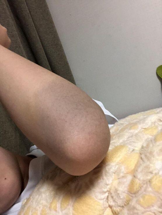 나도있어! 부모님 말로는 몽고반점이라는데 몽고반점은 궁둥이에 나는거자나.. 그래서 올려봐