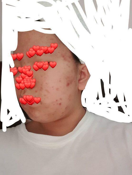 이제 15살된 여잔데 내가 손버릇이 안좋아서 여드름 보이는거는 다 뜯거든..? 그래서 이모양이됐는데 나많이 심각해? 이거 수술말고 답없는거야?ㅠ