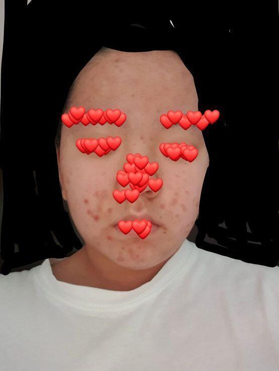 이제 15살된 여잔데 내가 손버릇이 안좋아서 여드름 보이는거는 다 뜯거든..? 그래서 이모양이됐는데 나많이 심각해? 이거 수술말고 답없는거야?ㅠ