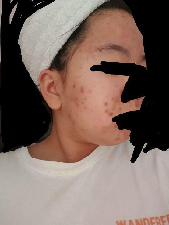 이제 15살된 여잔데 내가 손버릇이 안좋아서 여드름 보이는거는 다 뜯거든..? 그래서 이모양이됐는데 나많이 심각해? 이거 수술말고 답없는거야?ㅠ