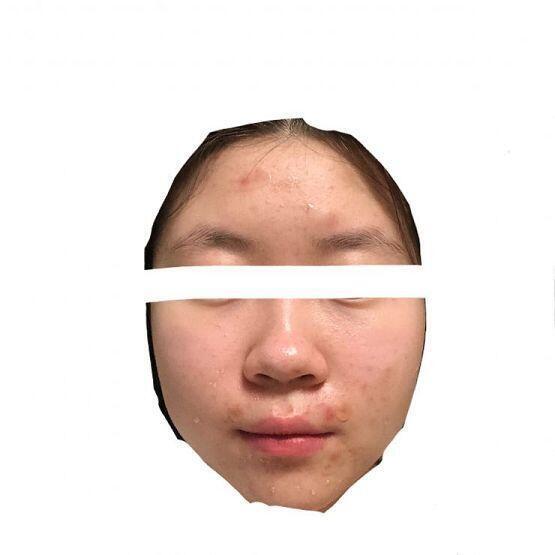 *사진약혐주의* ㅎㅇ여드름쟁이의 피부는 이래..^ 많이심하지,,??