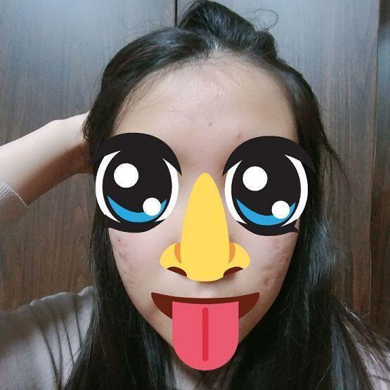 ⚠!!사진있음 혐주의!!⚠ •사진은 나아지는 과정용이라 눈코입은 스티커로 가렸어. 불빛때문에 여드름 없어보이는데 사진보다 더 붉어 일단 약 다 