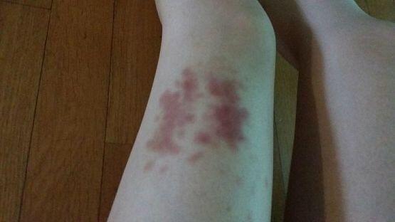 갑자기 다리에도 멍들고 그래. 손이 부운건 병원에선 그냥 약만바르고 가라하셨는데 왜이런거지?