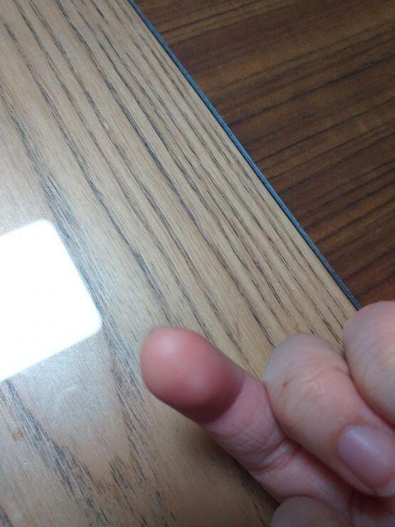 사진으로 잘 안보이는거같은데 지금 끝부분망 하얘ㅠㅠㅠㅠ 그 밑엔 엄청빨개지고 그 손가락만 저리고 딱딱함 어케