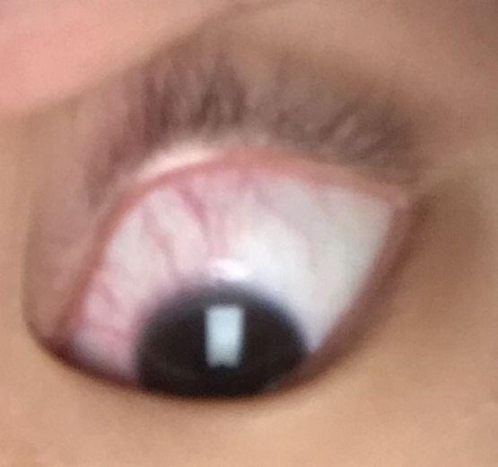 이건 좀 덜 한데 왼쪽ㅠㅅㅠ