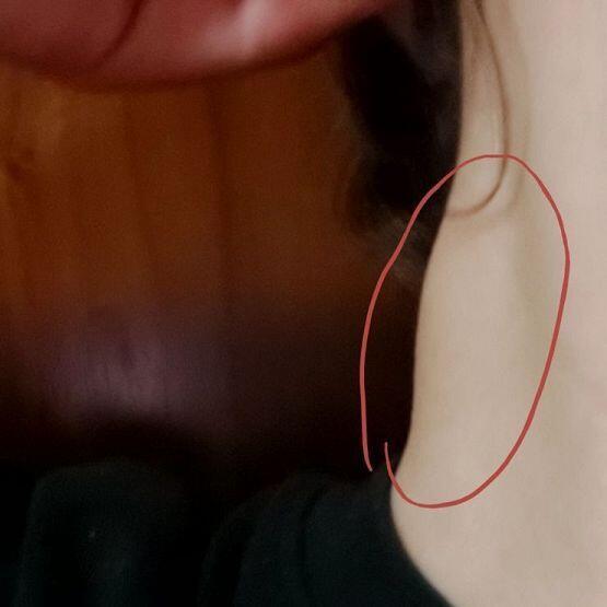이거바 이게 머지,, 아프진 않은데 개딱딱하고 사실 알게된 지 꽤 오래됐는데 아직도 있네.. 혹시 아는 사람은 조언 좀 해조