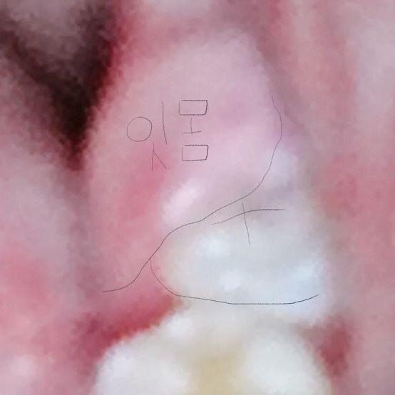 이빨 사진인데 혐오..?감 들 수도 있으니 보고 싶은 사람만 봐
