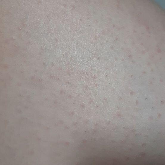 사진올릴께요 더심해졌어요 ㅜㅜㅜㅜ 빨간점이올라와요 ㅜㅜㅜㅜ 징그러울수도있으니 혐요스러우신분들은 안누르시는거추천... 사진은 허벅지에요