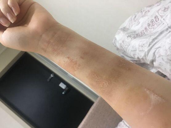 이 흉터임