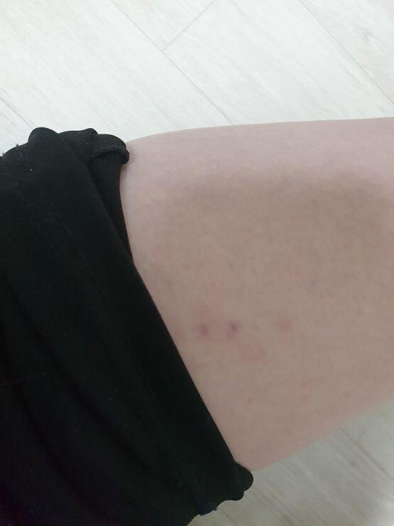 오늘 발견한 건 팔꿈치와 허벅지에 빨간 반점 같은 것 뾰루지처럼 튀어나온 것도 아니고 아프지도 않아