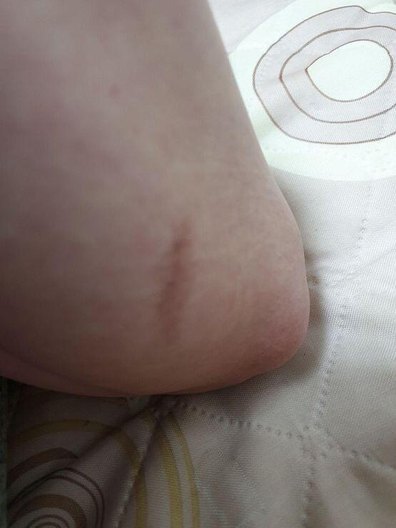 오늘 발견한 건 팔꿈치와 허벅지에 빨간 반점 같은 것 뾰루지처럼 튀어나온 것도 아니고 아프지도 않아