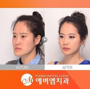 원래 얼굴도 진짜 작았는데 저렇게 왔었어 지금은 좀 교정 했는데 완벽하게 하고싶어