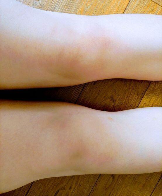 왜 이러는지 알 수 있어? (약간 까만부분이 무릎이야..왼쪽이 허벅지고 오른쪽이 종아리야)무릎 옆에 살 차이 좀 봐주라...