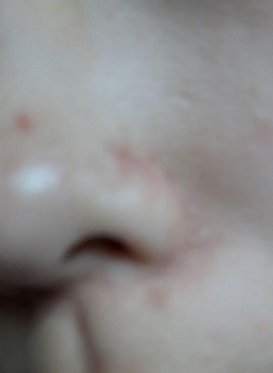 조금 징그러워ㅠㅠ!! 위에건 여드름이고 아래쪽에 울긋불긋 한건데.. 좀 오래됐어 이거 뭐야..?