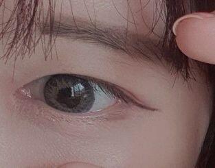 1.학생할인으로 150들었오 2.난 수면마취하고 잠들었을때 부분마취 해서 안아팠어 마취하고 다시 깨우더라구 3.실꼬매는 느낌 다 나구 피 나오는