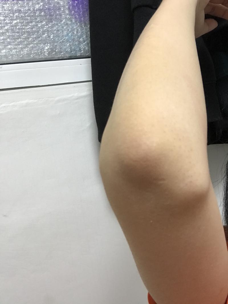 이게 사진으로 찍으니까 진하게 안나오는데 실제로는 이거보다 검은색이 훨씬 진해ㅠㅠㅠㅠ제발 내 팔꿈치 왜이런건지 좀 알려주라 ㅜㅜㅠ