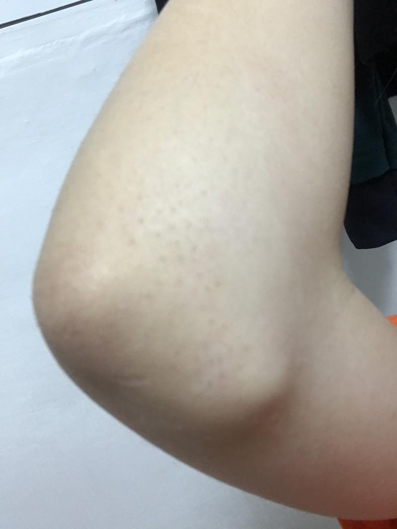 이게 사진으로 찍으니까 진하게 안나오는데 실제로는 이거보다 검은색이 훨씬 진해ㅠㅠㅠㅠ제발 내 팔꿈치 왜이런건지 좀 알려주라 ㅜㅜㅠ