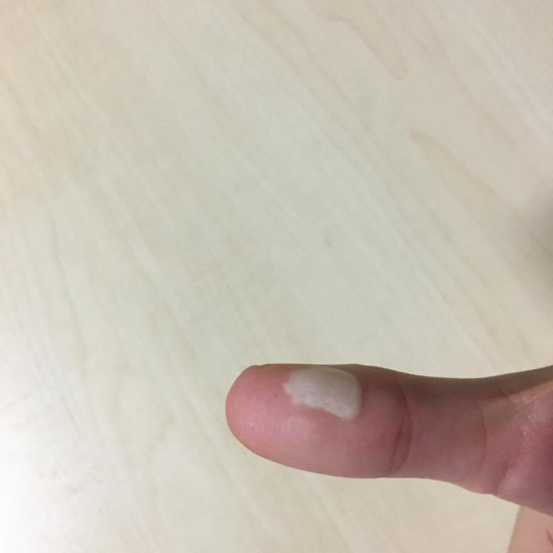 물집인지 뭔지 모르겠어 ㅠ