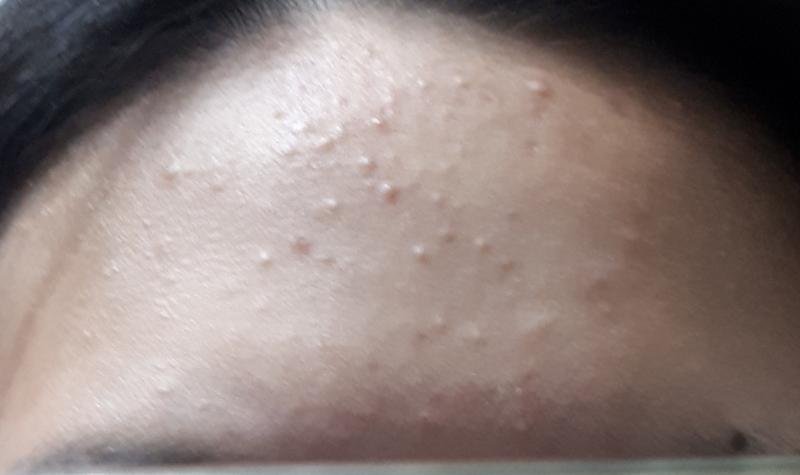 시험기간이랑 친구문제랑 겹친데다 곧있으면 그날이기까지 해서 피부 나빠질 것 같다 생각은 했는데... 이거 원래대로 돌아올 수 있을까..