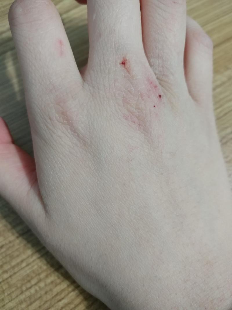 하루... 하루 안 발랐을 뿐이다...