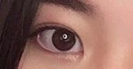 쌍수 후