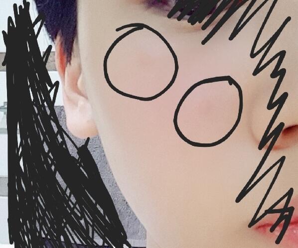 이거ㅠ 하나는 이마에 났고 둘운 볼에ㅠ