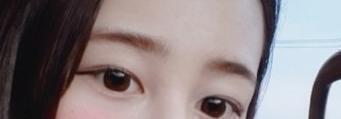 이건 수술전 사진이야 보다시피 작은눈은아니였고 속쌍도있어!! 근데 뭔가밋밋해보이지?ㅠㅠ 난그게고민이었어 얼굴이 너무평범한거. 그래서 의사선생님과