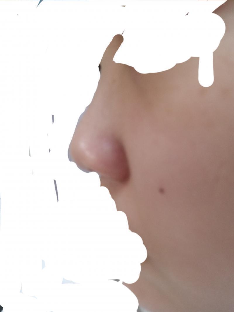 아무도 날 알아봐주지 않길 바라며.... 1일차야! 시간 날때마다 1분 이상씩 마사지중! 손은 깨끗이 씻고