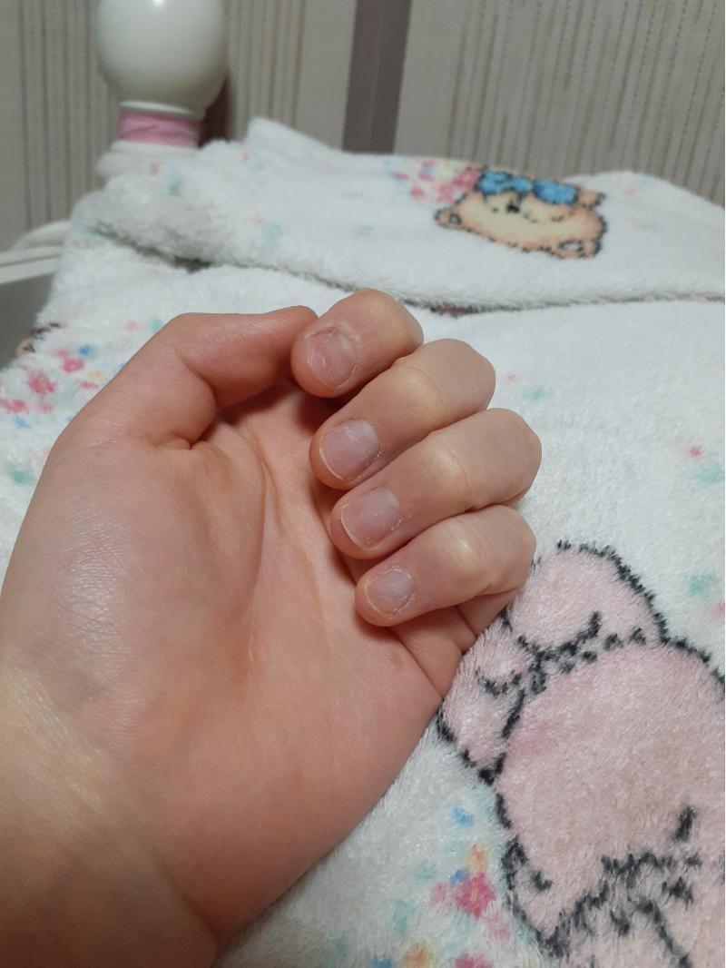 난 내 친구가 내손보고 놀라서 괴물손같다고....놀렸당.. 그래서 항상 손 내밀때 창피했어 그 계기로 의식하게 되고 고쳐서 지금 마니 길렀어 정