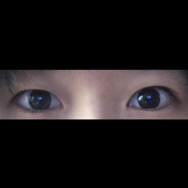 쌍수 전 내 눈이야 한쪽에 얇은 속쌍이 있고 한쪽은 쌍커풀 얇게 두겹이어서 말려들어가서 심한 짝눈인。。