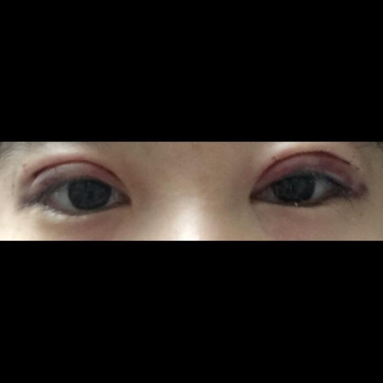 12월 21일。 그러니깐 저번주 토요일에 쌍수 했엉 이 사진은 쌍수 다음날 사진이야 충격 먹었거든 이 날。。 전날보다 팅팅 붓고 멍이