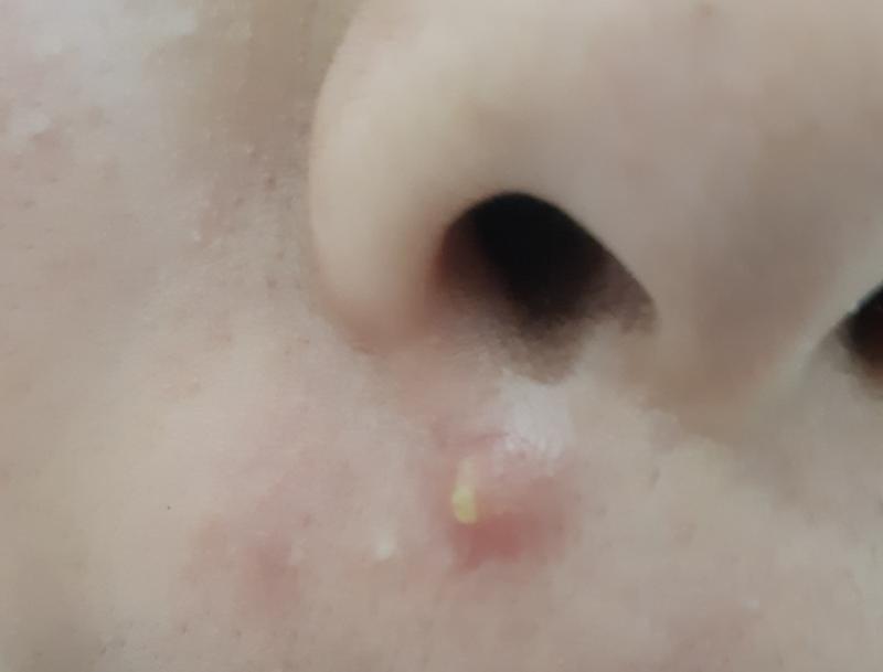 여드름 사진이니까 보기 싫은 사람ㄷ들은 보지마