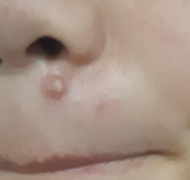 여드름 사진이니까 보기 싫은 사람ㄷ들은 보지마