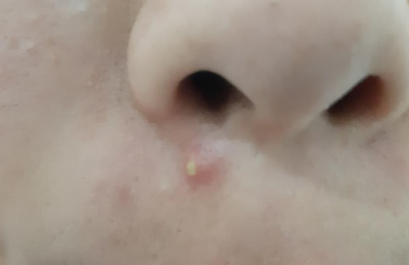 여드름 사진이니까 보기 싫은 사람ㄷ들은 보지마