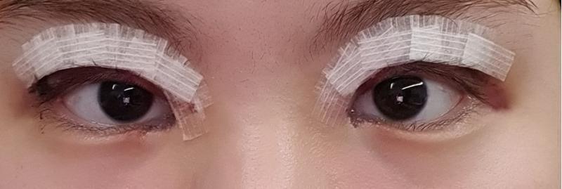1/3 수술 1일차 혐짤주의 내눈은 애초에 라인을 높게 잡아서 예쁠 눈이 아니라고 하심. 따라서 라인은 그렇게 높지 않게 나옴. 근데 일단 내 