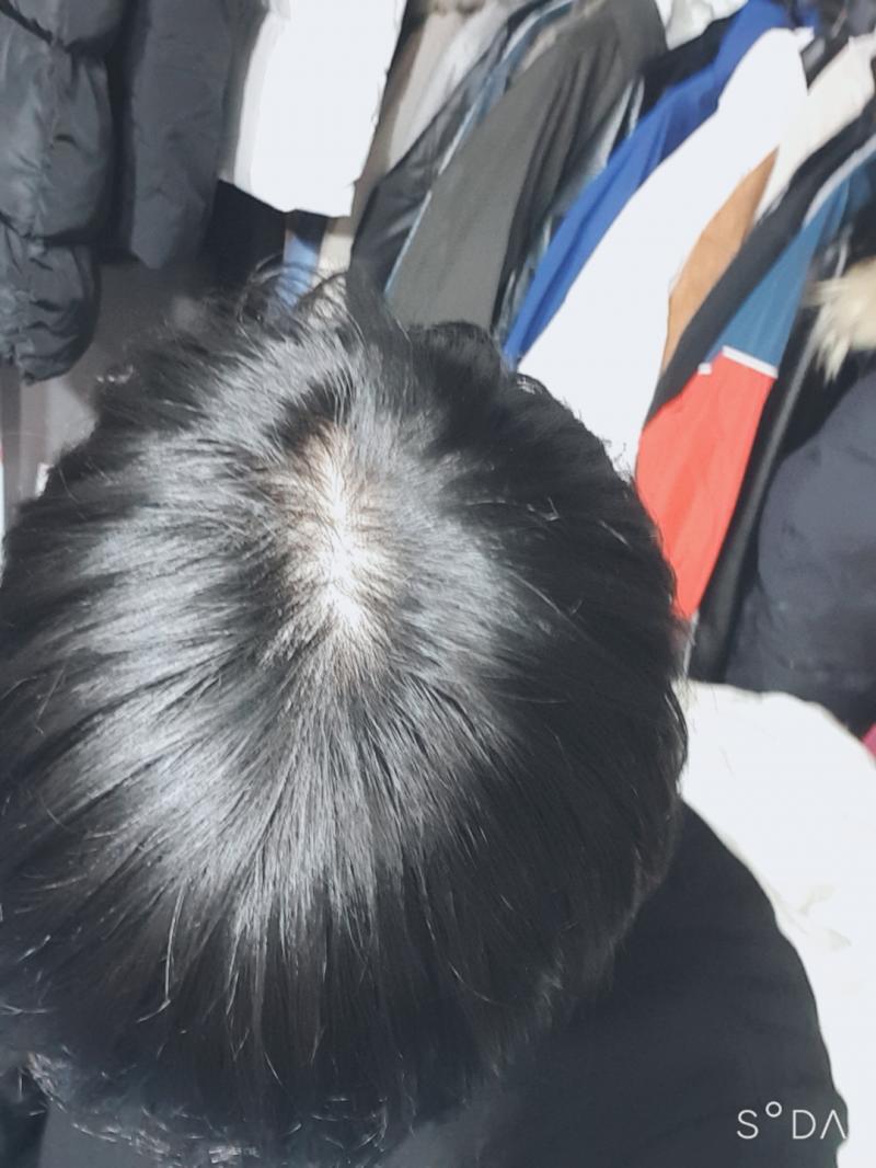 아니..머리가 슬슬 벗겨지길래 어느정돈지 보려고 찍었는데..하필 이거라고?