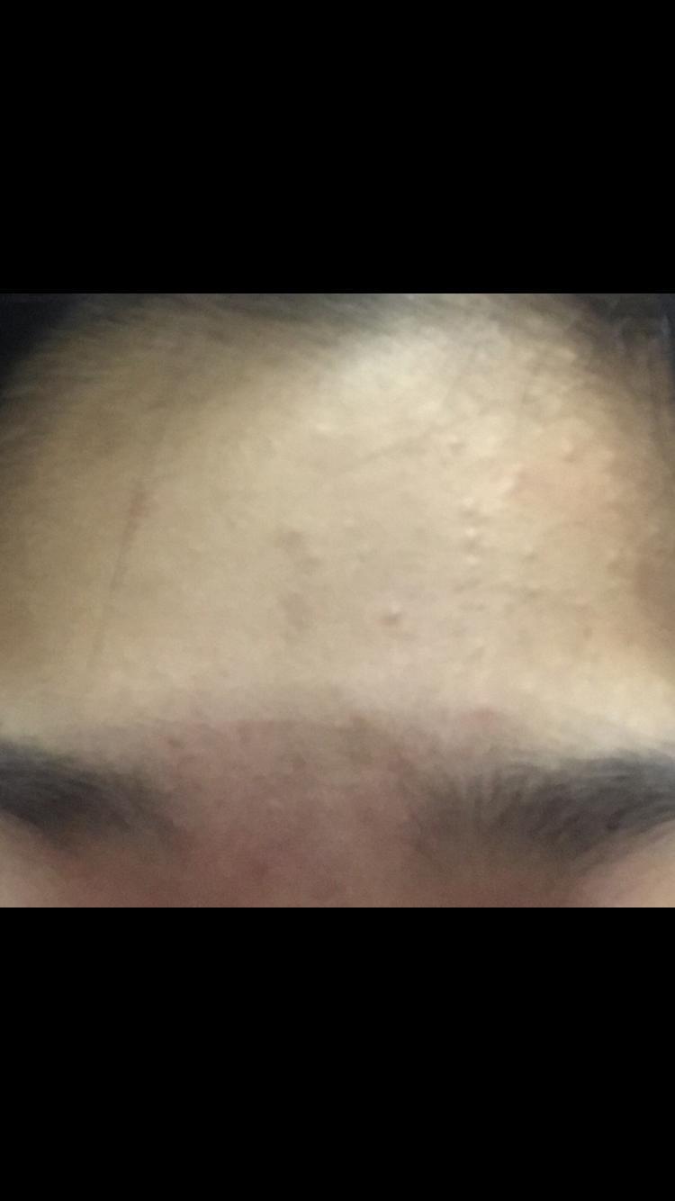 이게 제일 나아졌을땐데 앞머리까니깐 이렇게 됬다가 다시 계속 나고있어 ㅜ