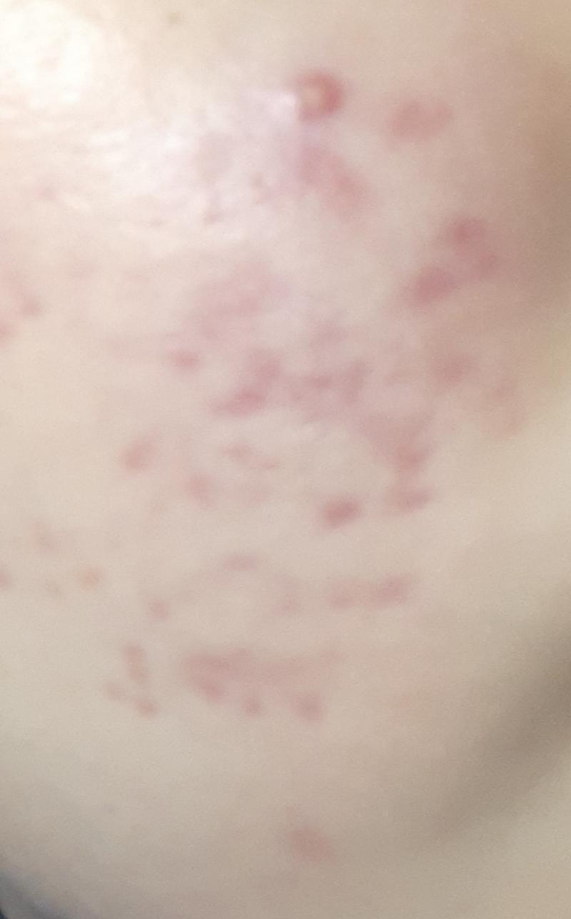 여드름 색소침착이 있고 첫번째 사진 여드름은 생리주기라 나타난거야