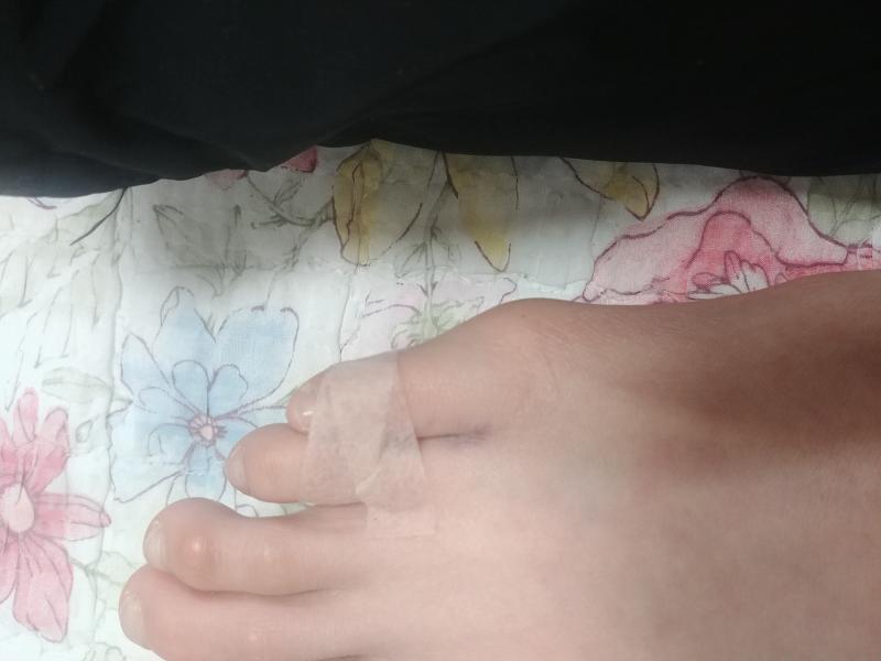 병원에서 4번째랑 새끼발가락에 테이핑을 해왔거든(거치대같은 용도로?)사진에서 보면 잘안보이겠지만 이정도 상처라면 딱히 반깁스 안해도 되는 걸까?
